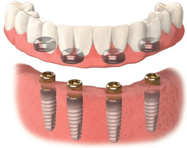 easy snap dental bridge