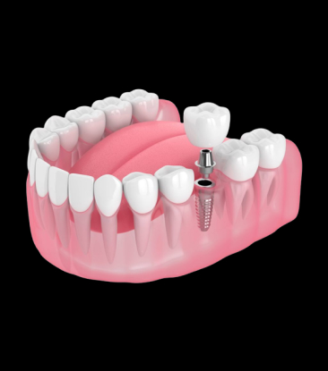 Single Tooth Replacement